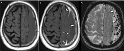 MRI appearance of chronic subdural hematoma